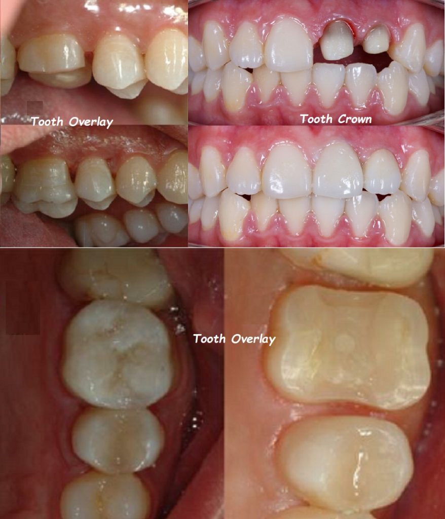 tooth overlay vs crown