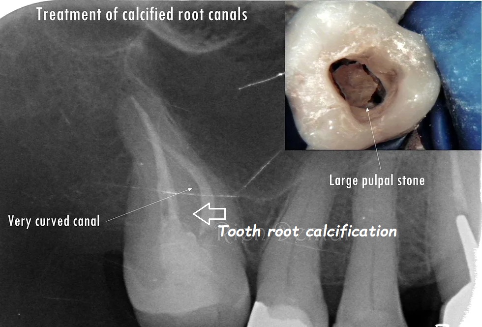 tooth root calcification