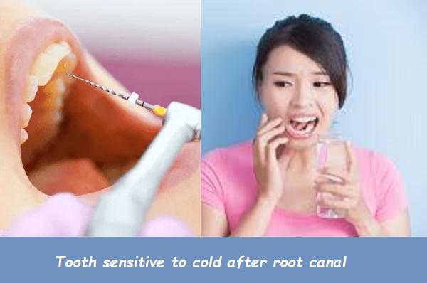 Tooth sensitive to cold after root canal