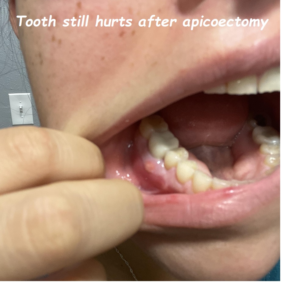 Tooth still hurts after apicoectomy