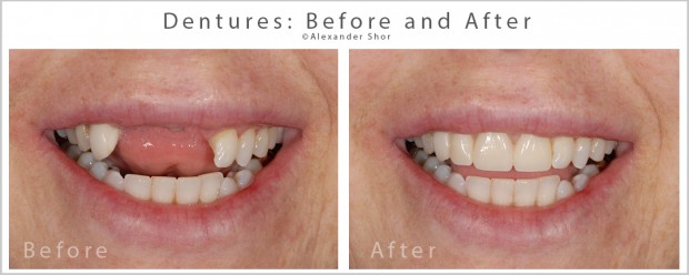 top front front tooth partial dentures