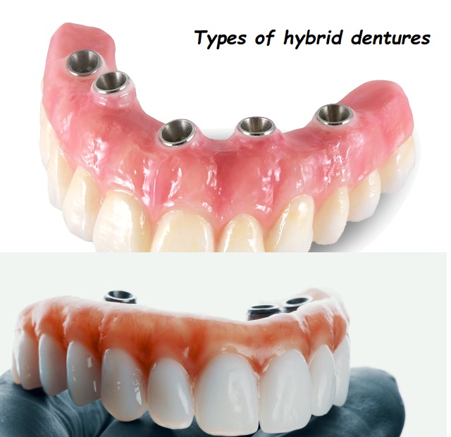 Types of hybrid dentures