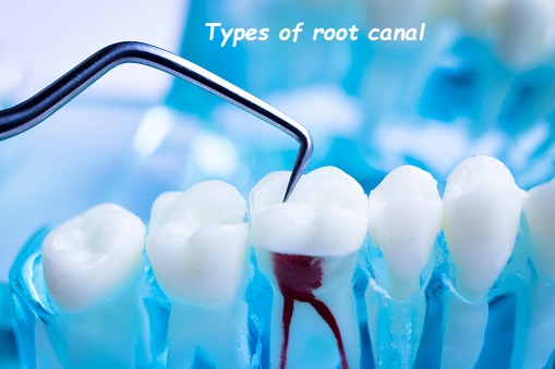 types of root canal