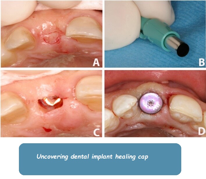 uncovering dental implant healing cap