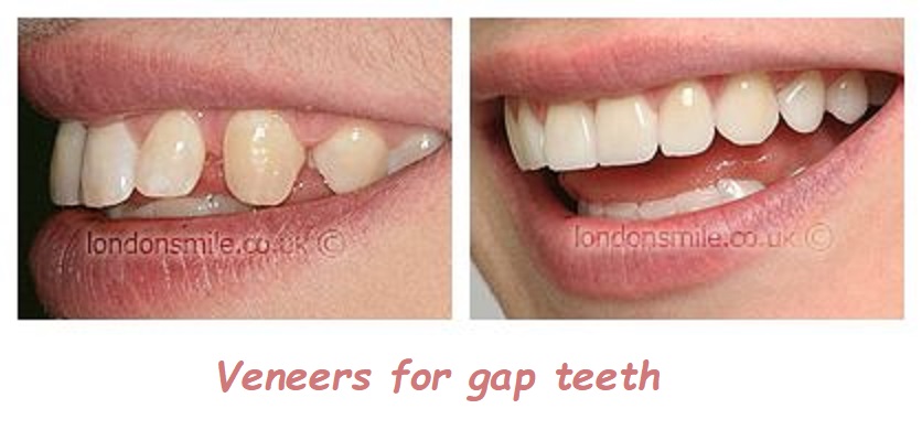 Veneers for gap teeth