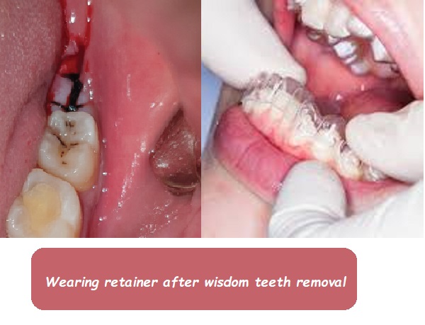 wearing retainer after wisdom teeth removal