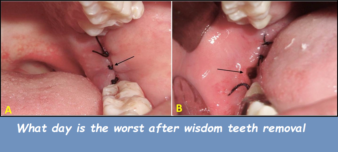 What day is the worst after wisdom teeth removal