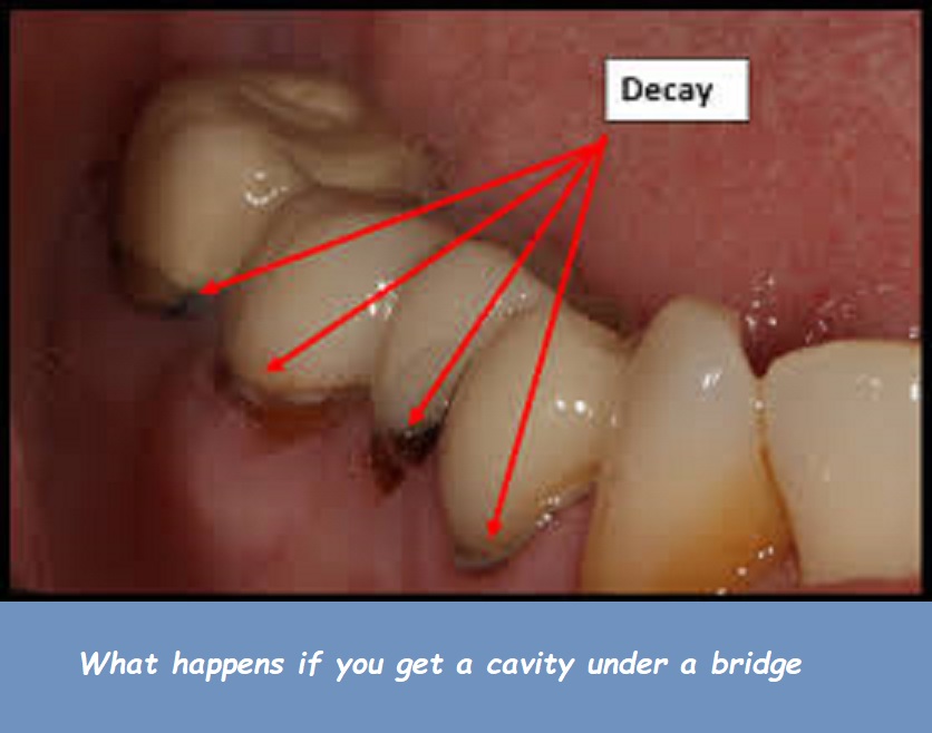 what happens if you get a cavity under a bridge