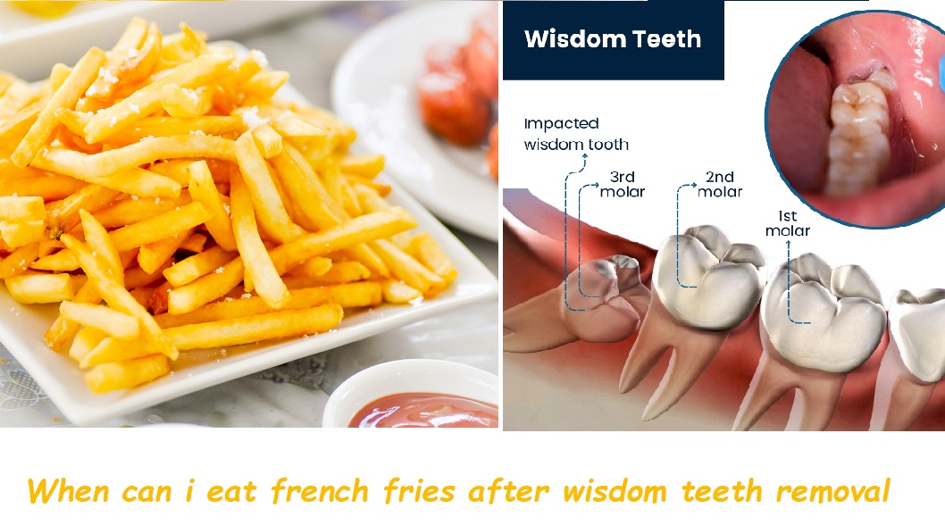 When can i eat french fries after wisdom teeth removal