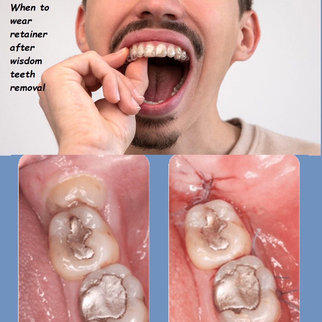 When to wear retainer after wisdom teeth removal