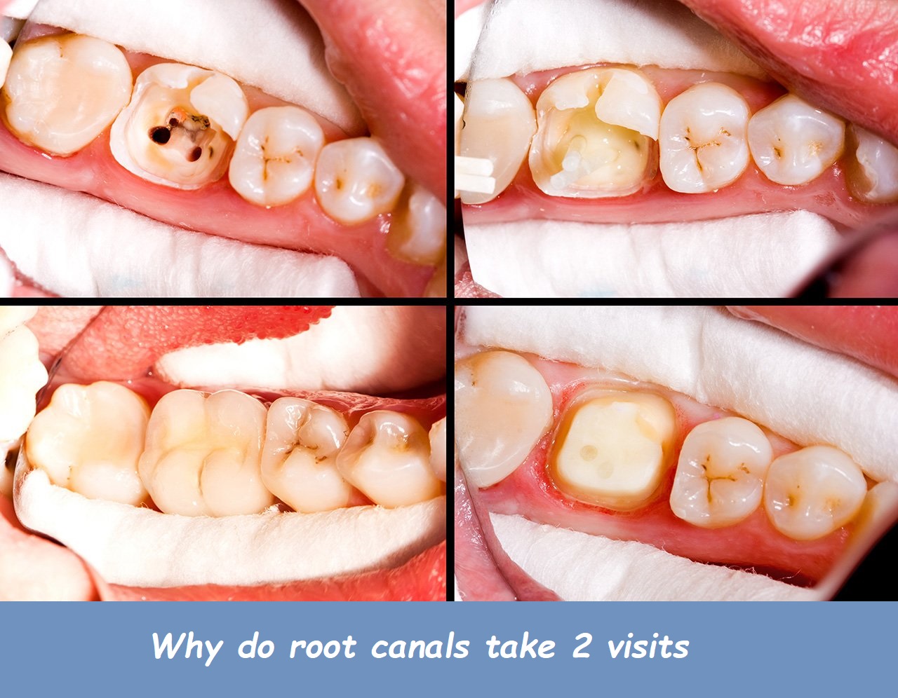 Why do root canals take 2 visits