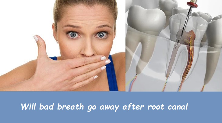 Will bad breath go away after root canal