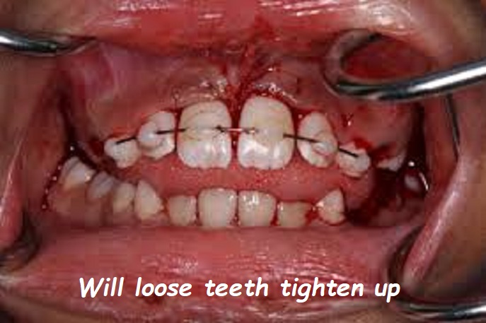 Will loose teeth tighten up