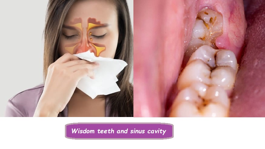 Wisdom teeth and sinus cavity