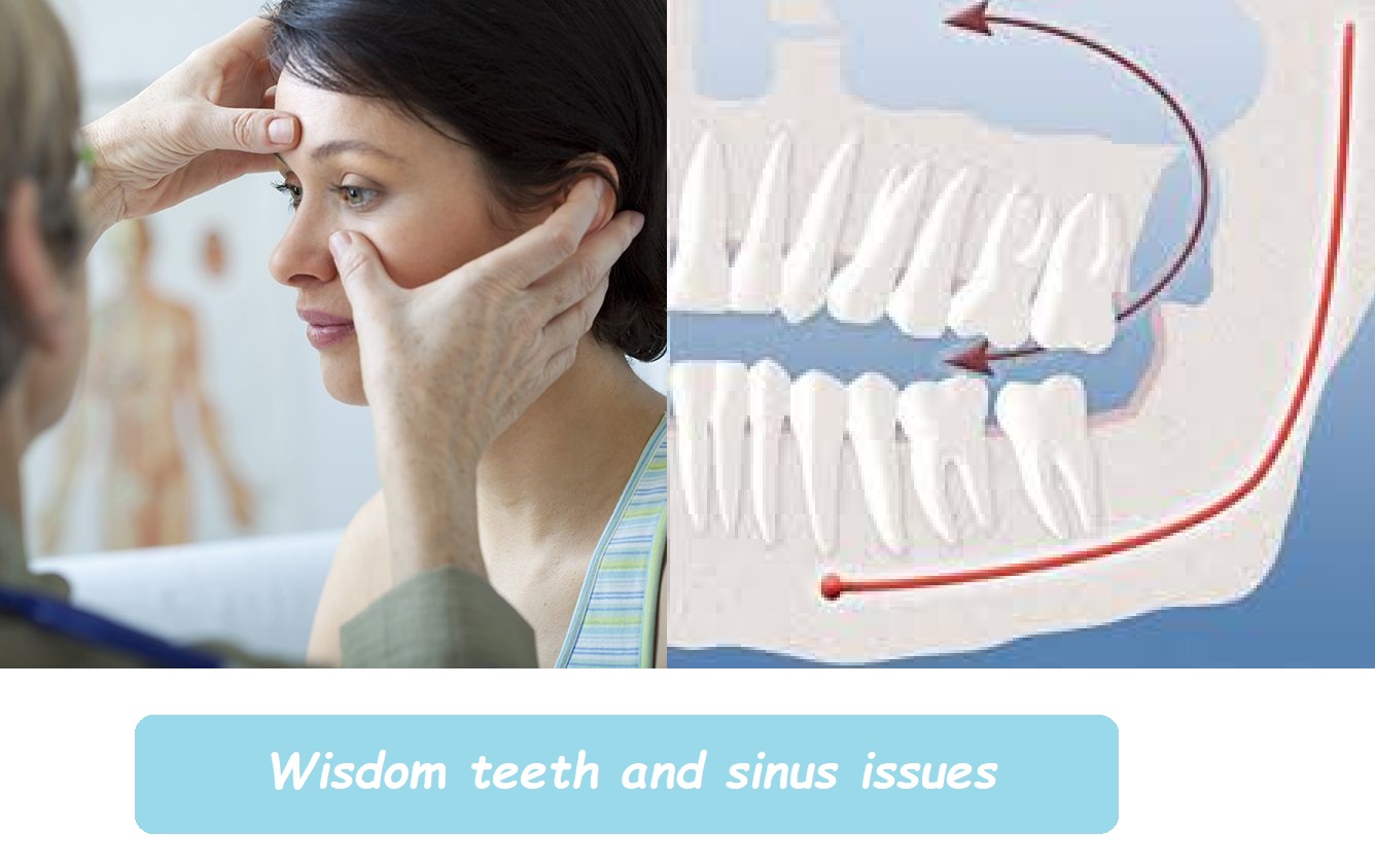 Wisdom teeth and sinus issues