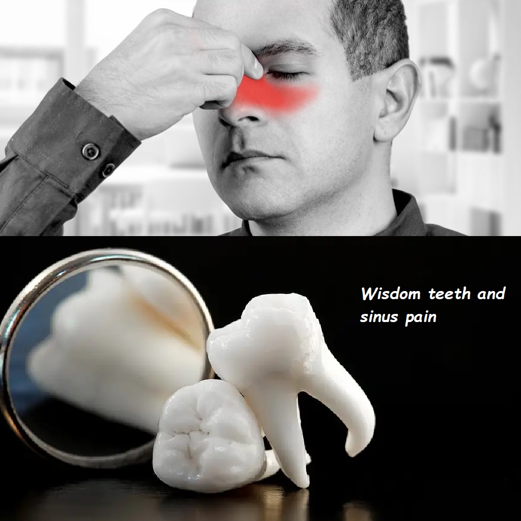 Wisdom teeth and sinus pain