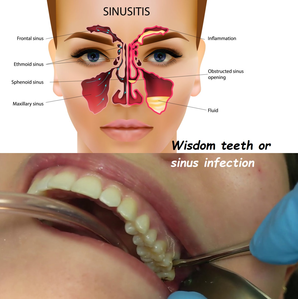 Wisdom teeth or sinus infection