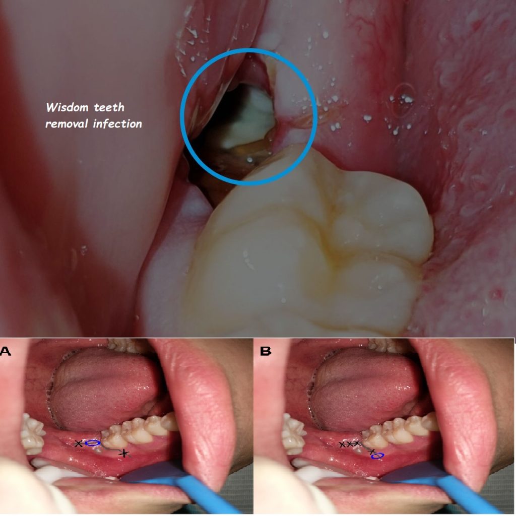 Wisdom teeth removal infection