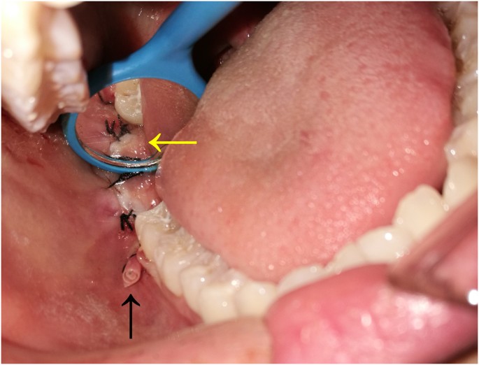 Wisdom teeth removal infection