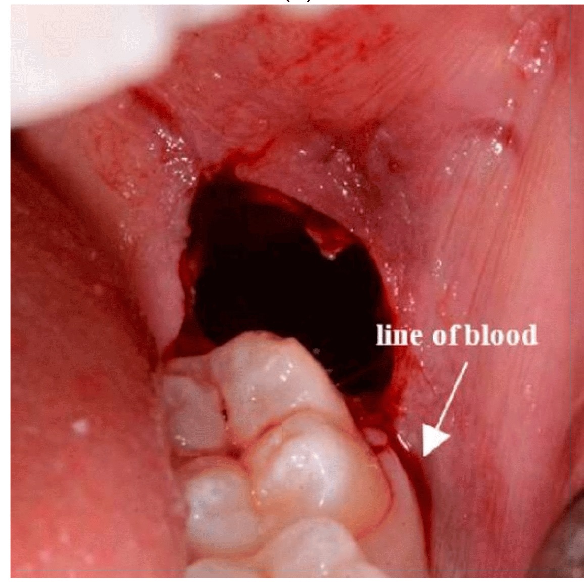 Wisdom teeth removal infection