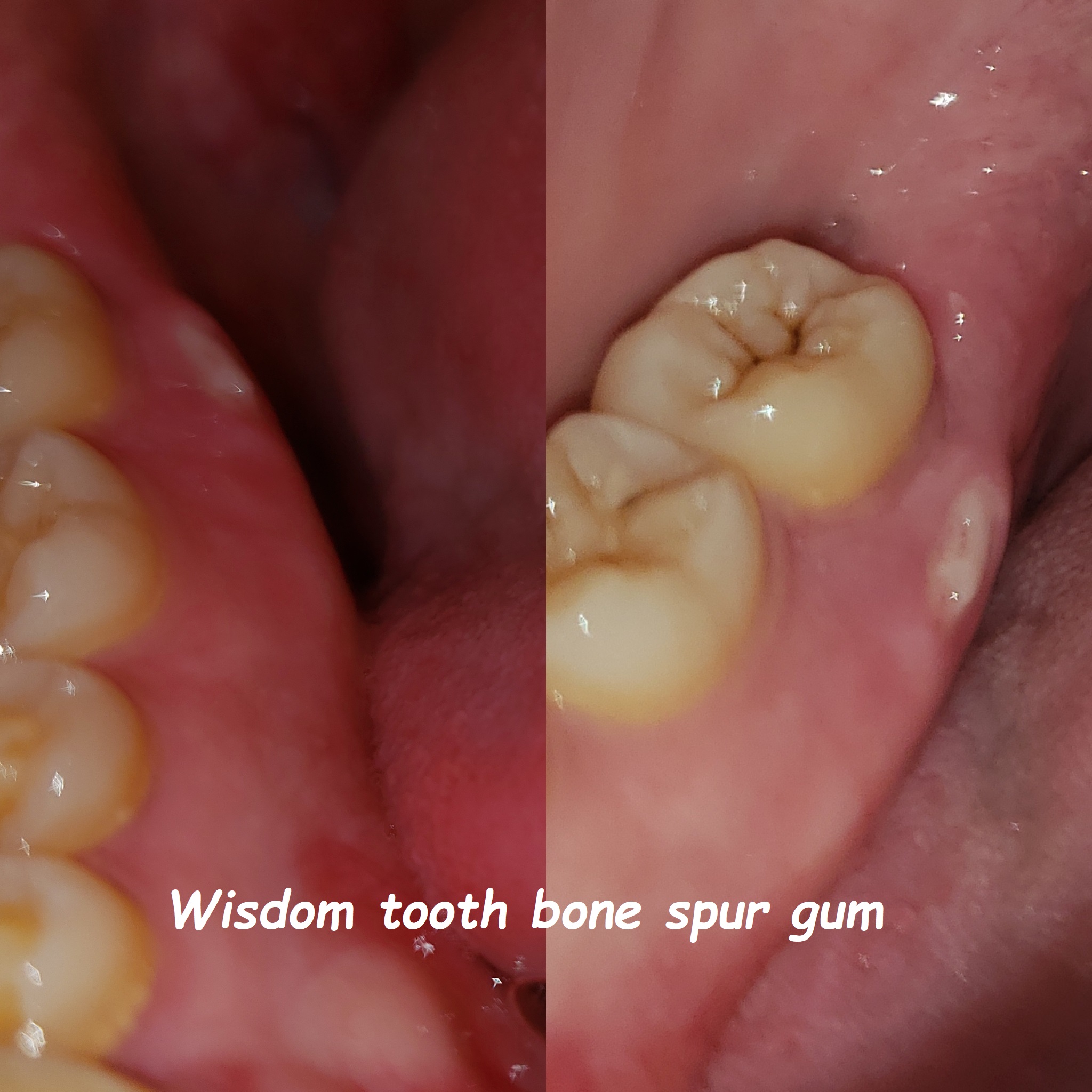 Wisdom tooth bone spur gum