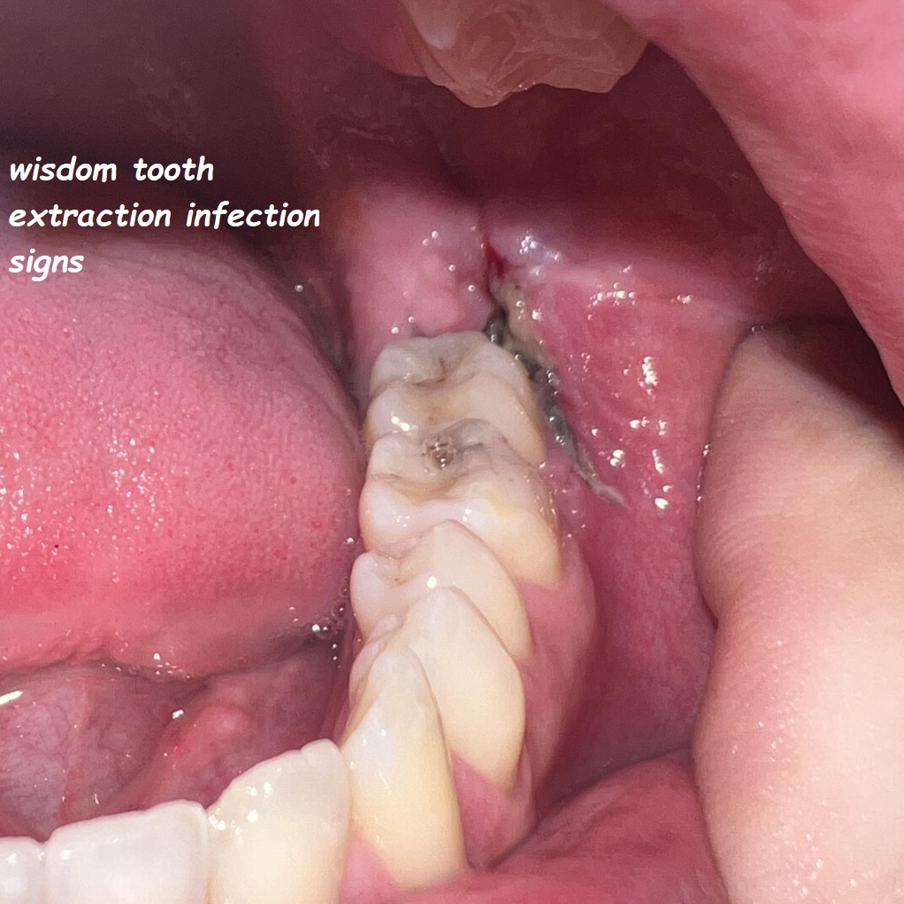 wisdom tooth extraction infection signs