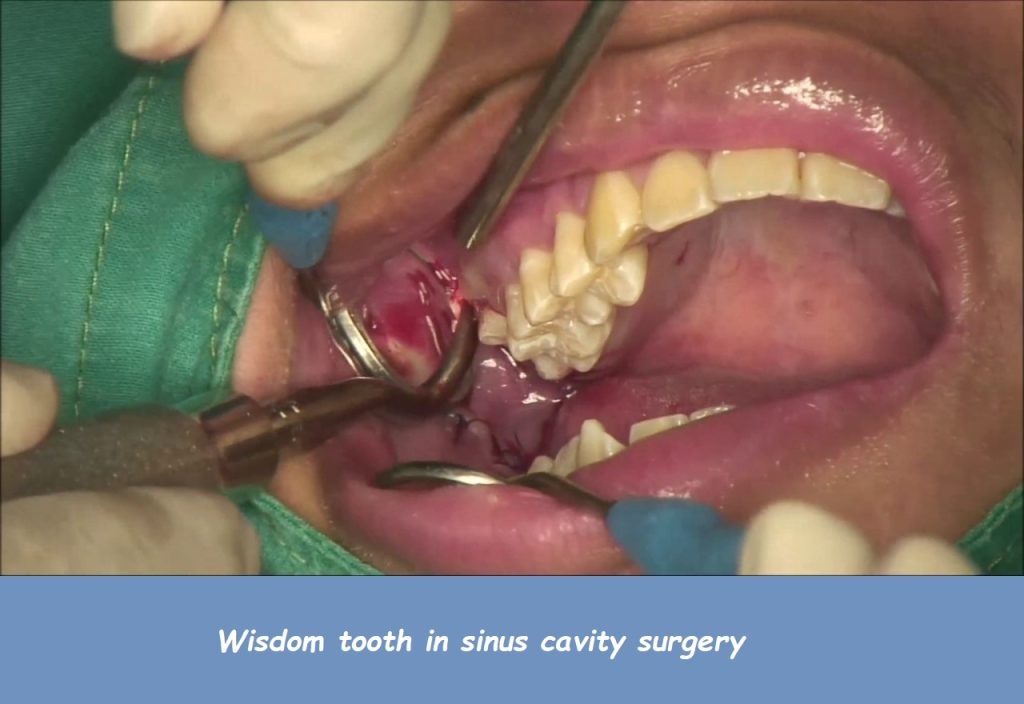 wisdom tooth in sinus cavity surgery