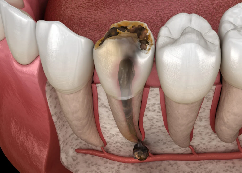 3D-illustration-of-a-severe-tooth-decay-The Dangers of Not Treating Cavities Path to Rotten Teeth