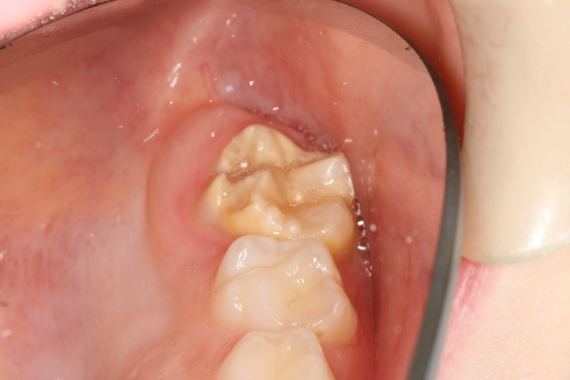 Genetics and Rotten Teeth: How Much is Hereditary?