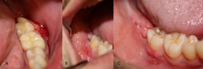 Acceptable-wound-healing-Note-the-dehiscence-in-the-horizontal-incision-Wisdom tooth wound recovery and healing stages after extraction