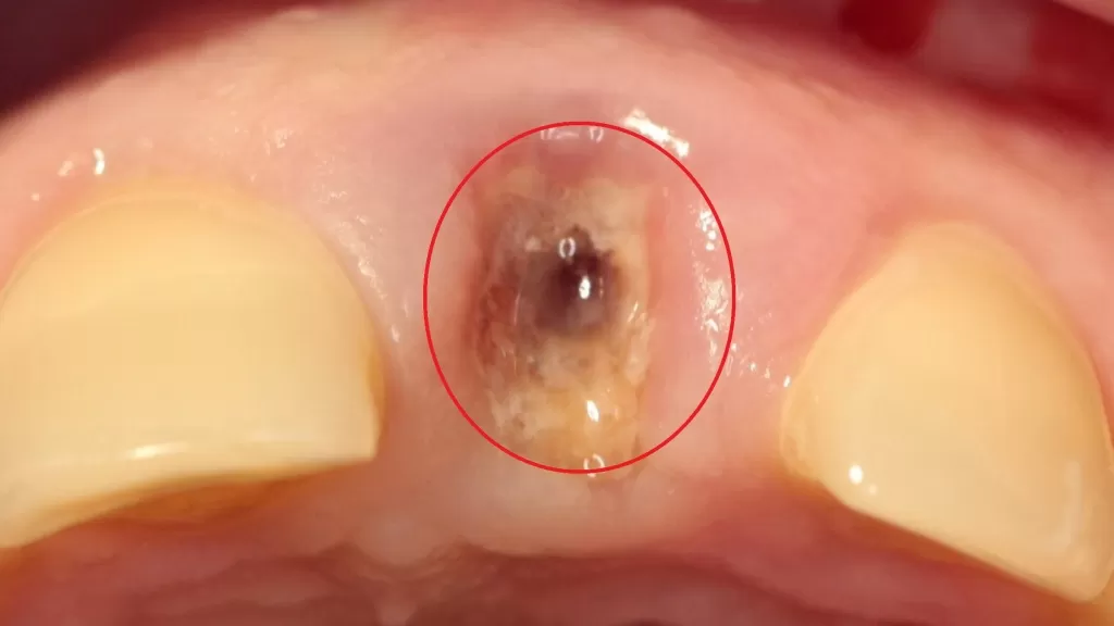 After Tooth Extraction Normal Socket is turned to dry socket due to loss of blood clot creating a hole in gum