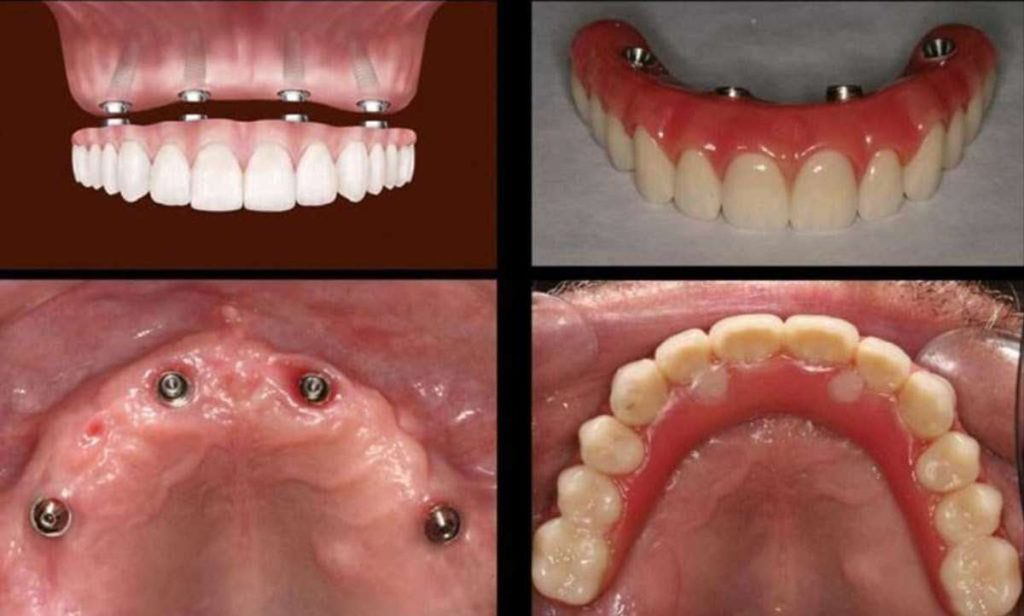 All-on-4 Dental implants for upper teeth.