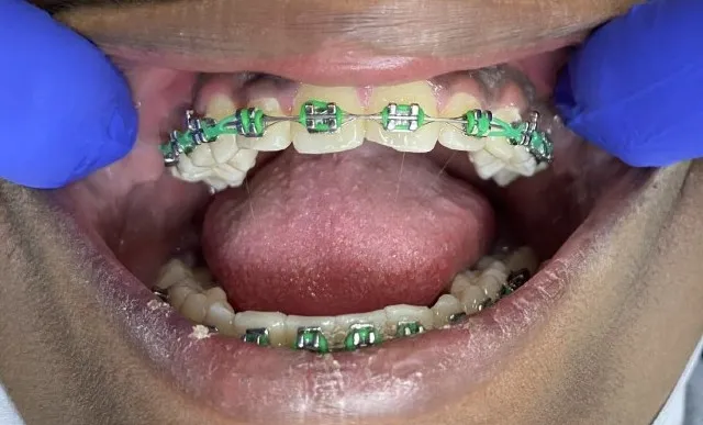 Bad Teeth? Here’s Everything You Need to Know About Getting Braces for a Healthier, Straighter Smile