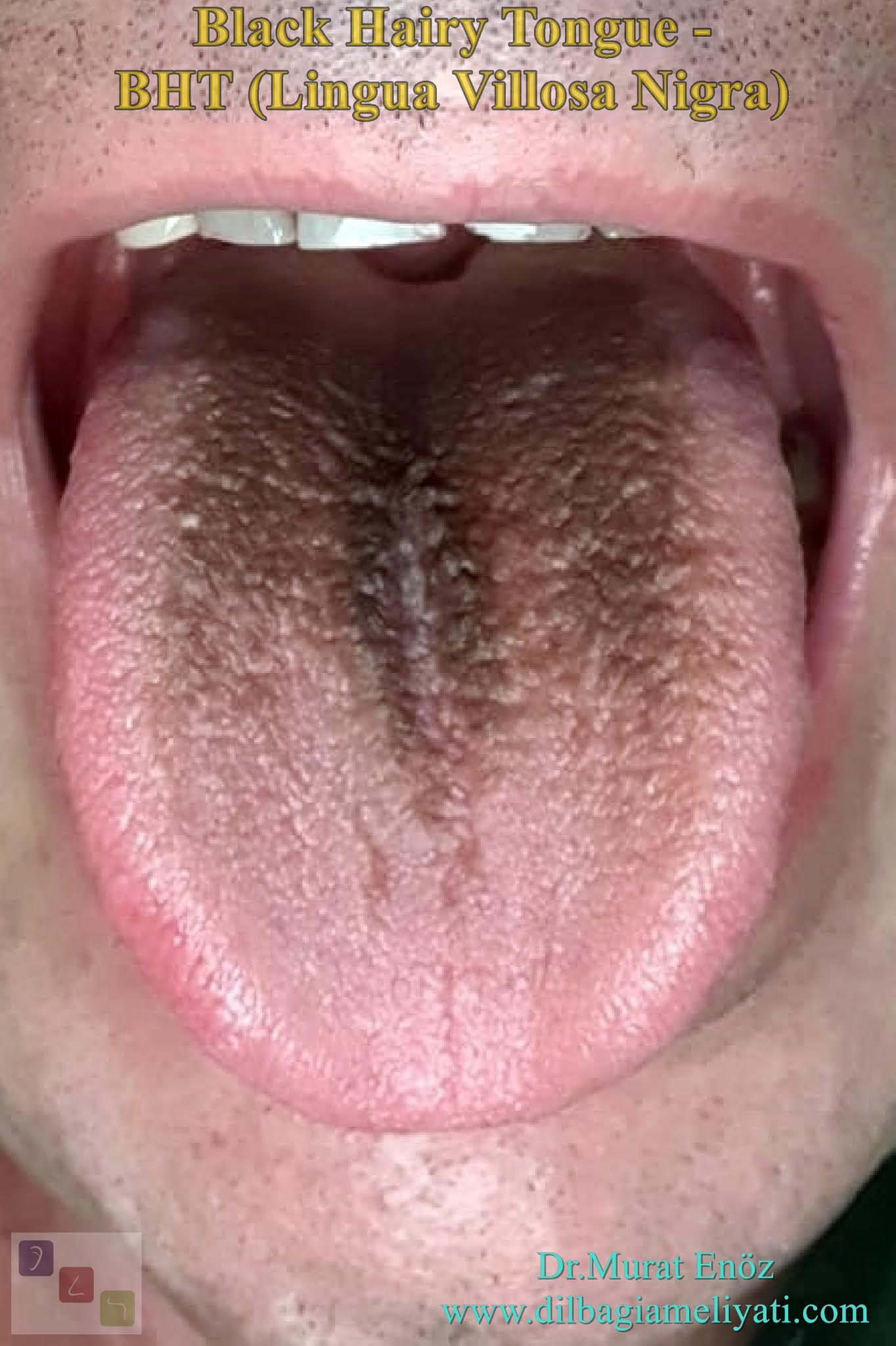 Black Hairy Tongue (Lingua Villosa Nigra) as black spots on tongue