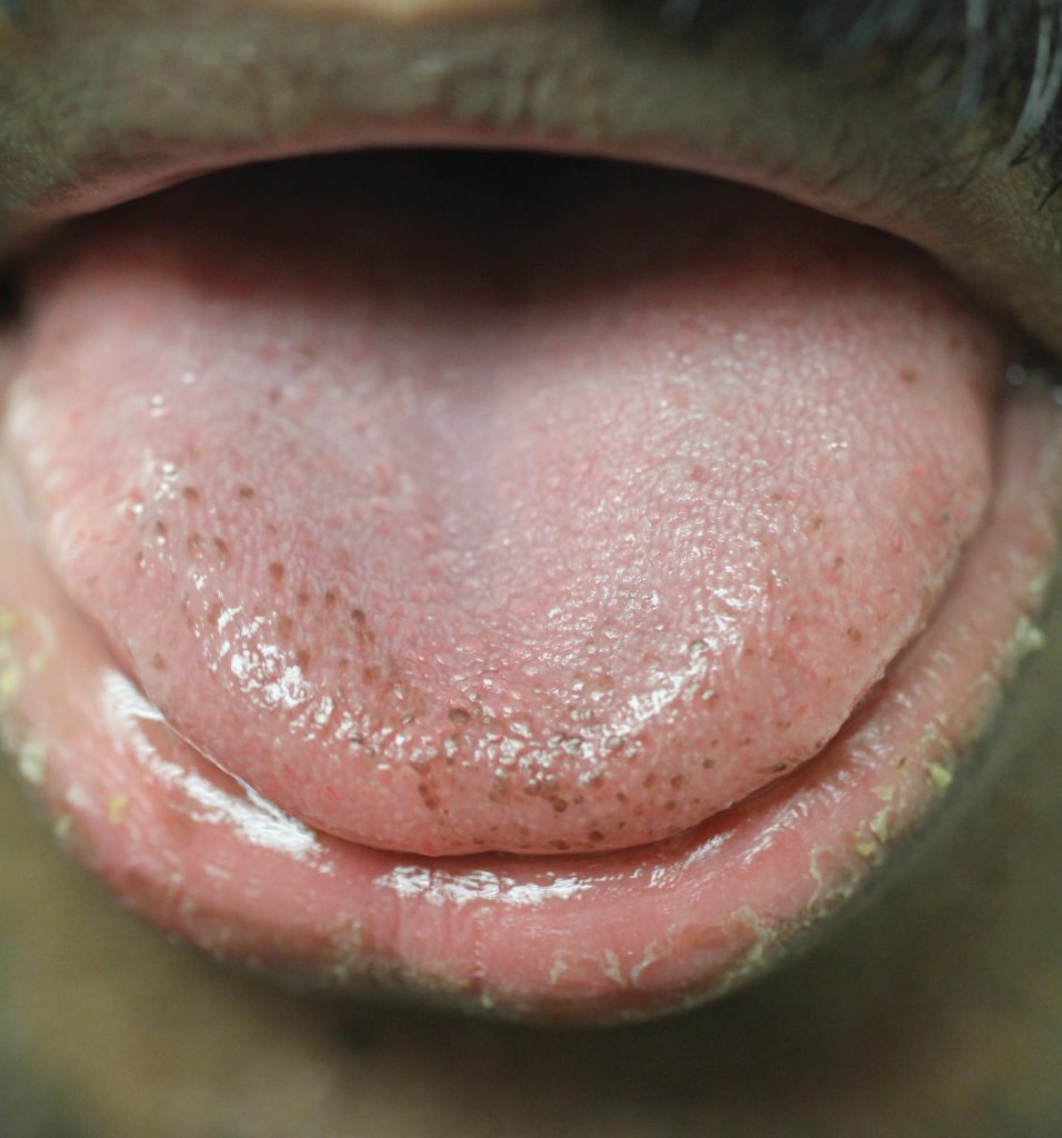 Black Spots on Tongue: Causes, Symptoms, and When to Seek Medical Advice