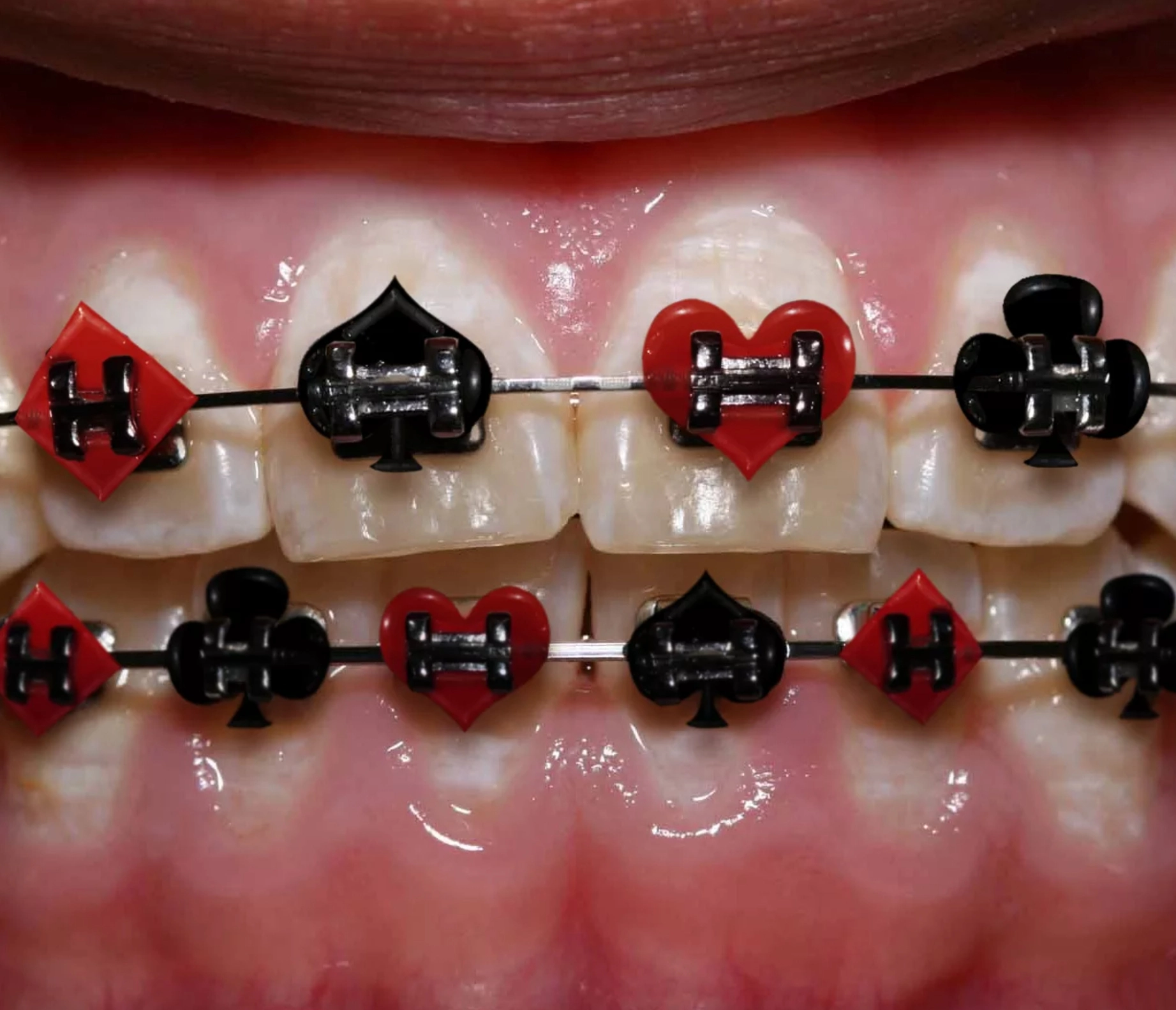 Blue-black-rd-braces-colors-braces-Best Braces Colors-transparent-