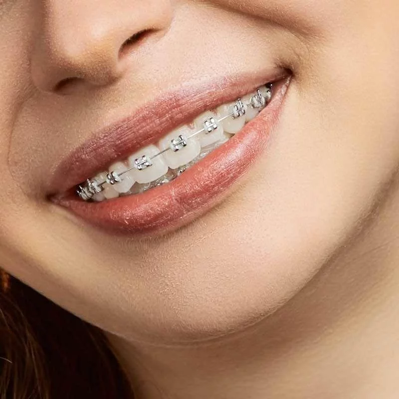 Blue-braces-colors-braces-Best Braces Colors-transparent-