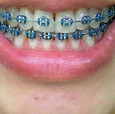 Blue-braces-colors-braces-Best Braces Colors