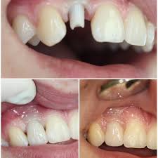 Broken tooth repair with dental implant and crown