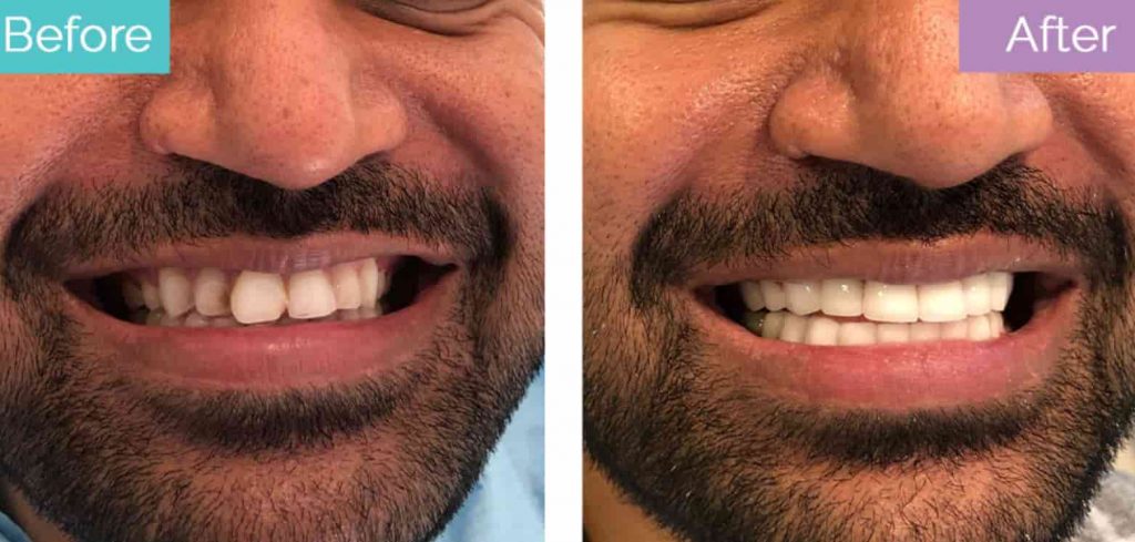 How to Fix Buck Teeth Without Braces: Alternative Treatments and Solutions