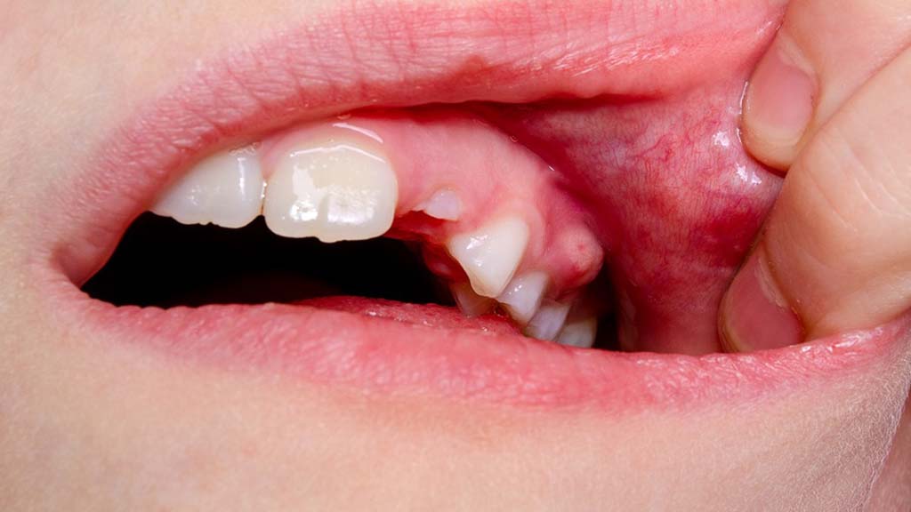 Bump on Gums: Causes, Symptoms, and Treatments for Gum Cysts, Lumps, and Bumps