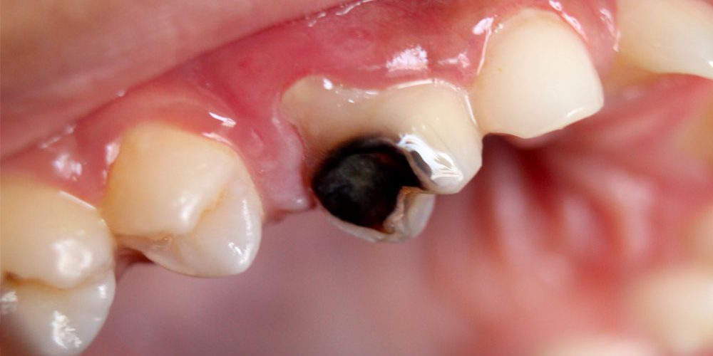 Can Chewing Ice Lead to Cavities?