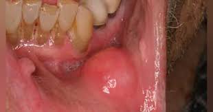 cancer lump on jawline, non movable lump on jaw bone, hard lump on jaw bone under skin, 