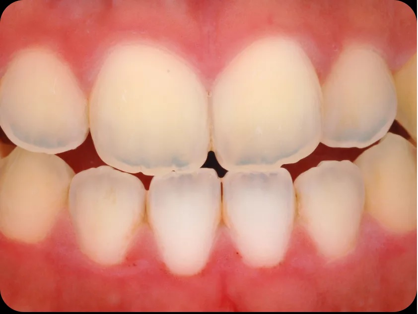 Causes of Translucent Teeth: Why Your Teeth Look See-Through