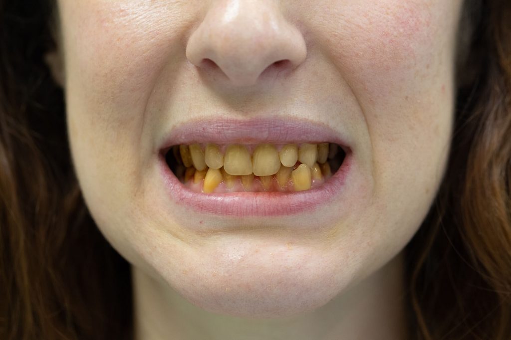 Certain Diet(eggs, colored drink, Tea, Color food) Cause Yellowing Teeth