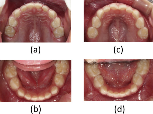 Child teeth view showing how many teeth kids are having