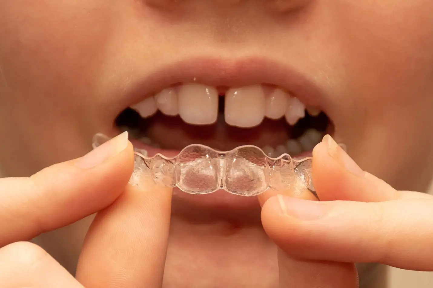 Clear Aligners to reduce gap between teeth at home