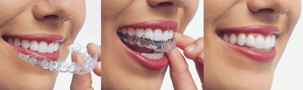 Clear retainer for upper teeth