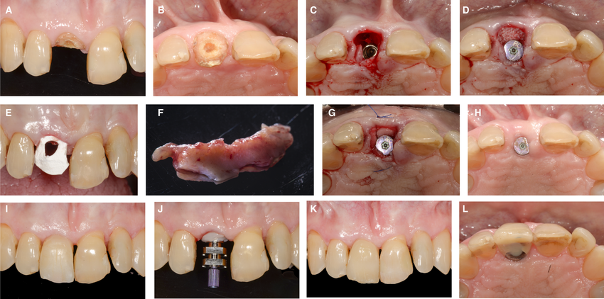 Comprehensive Guide on the Healing Process for Tooth Implants: What to Expect at Every Stage