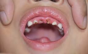 Common Causes of Tooth Decay in Children